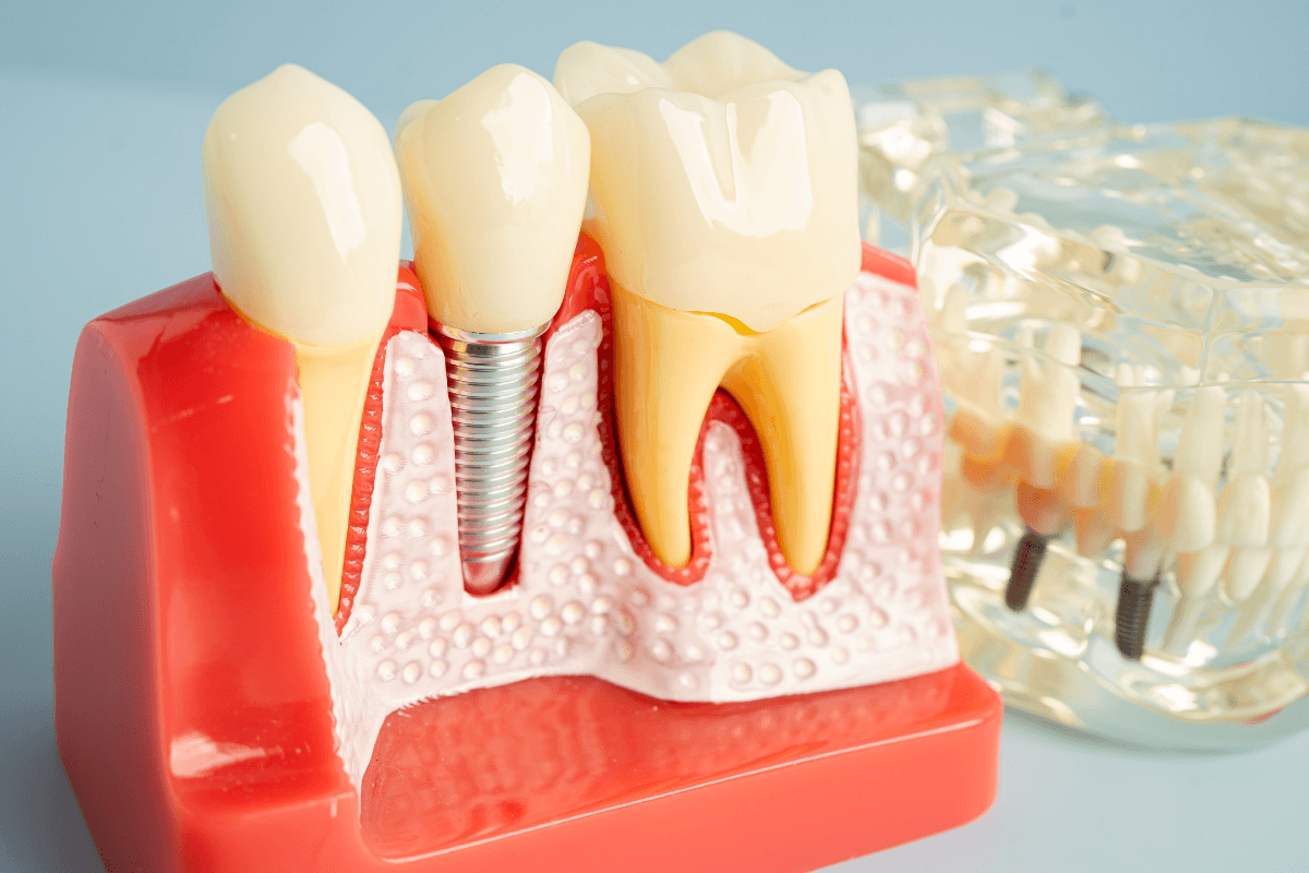 Complete Guide to Dental Implants