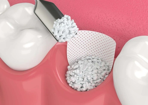 bone grafting in huntington beach