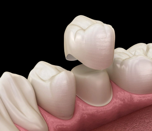 crown lengthening in huntington beach