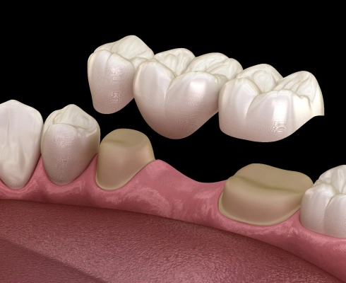 dental bridges in huntington beach