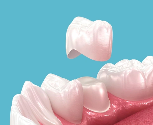 dental crowns in huntington beach