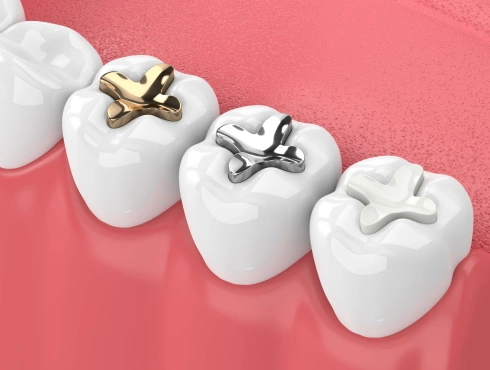 dental fillings in huntington beach