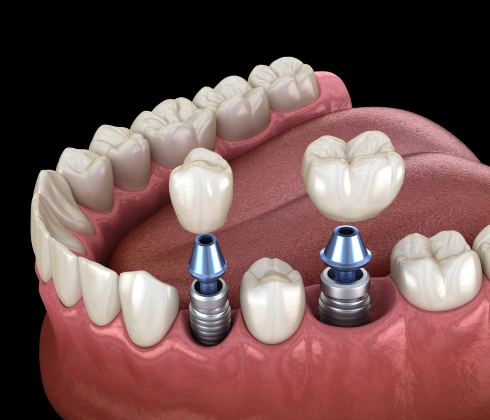 dental implants in huntington beach