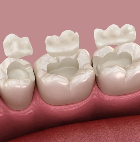 inlays onlays in huntington beach